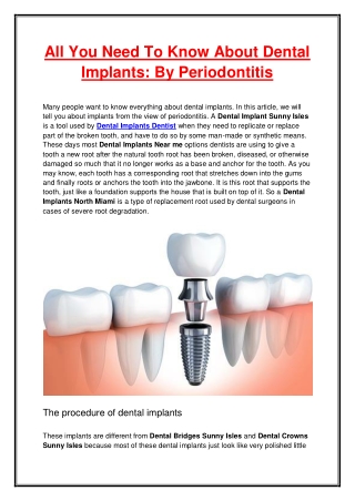 All You Need To Know About Dental Implants By Periodontitis