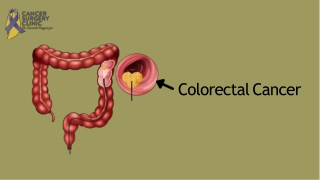 Colorectal Cancer Treatment in Mumbai
