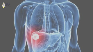 Liver Cancer Treatment in Mumbai