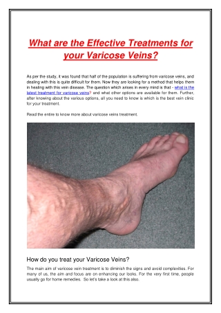 What are the Effective Treatments for your Varicose Veins