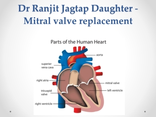 Dr Ranjit Jagtap Daughter -  Mitral valve replacement Surgery