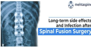 Long-term side effects and Infection after Spinal Fusion Surgery | Mehta Spine