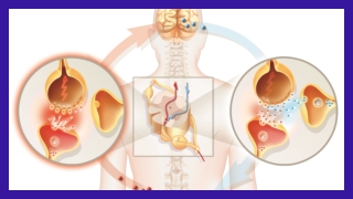 Neuropathic Pain Causes
