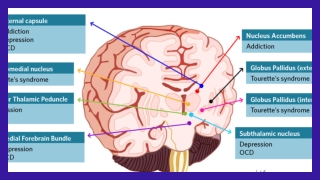 Neurological Disorders