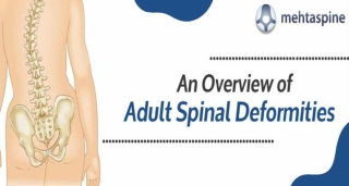 An Overview of Adult Spinal Deformities | Mehta Spine