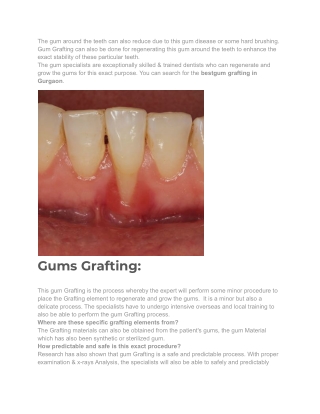 Best Gum Grafting in Gurgaon