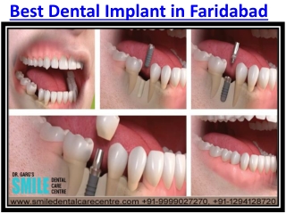 Best Dental Implant Treatments Clinic in Faridabad India