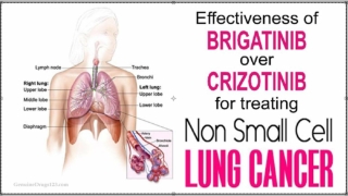 The Effectiveness of Brigatinib over Crizotinib for Treating Non-Small Cell Lung Cancer