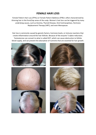 Female Hair Loss Treatment