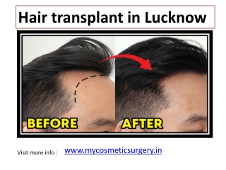 Hair transplant in Lucknow