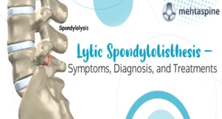 Lytic Spondyloisthesis Symptoms, Diagnosis, and Treatment