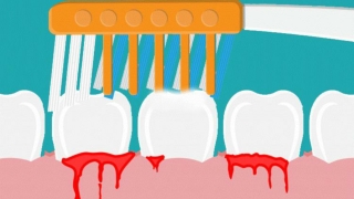 BLEEDING GUMS AND HEART DISEASE