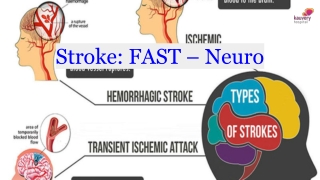 Stroke_ FAST – Neuro