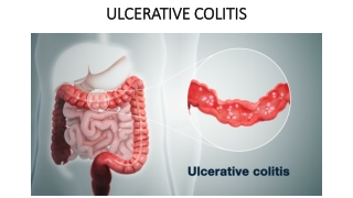 Treatment for Ulcerative Colitis