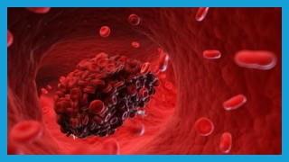 Symptoms of Blood Clot