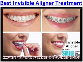 Best Invisible Aligner Treatment in our Dental Clinic Faridabad