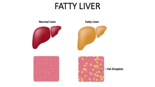 How do I Cure Fatty Liver Naturally?
