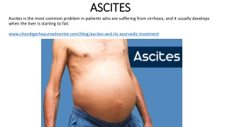 Ayurvedic Treatment for Ascites