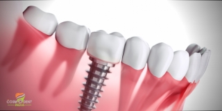 Best Hospital For Dental Implants in Gurgaon