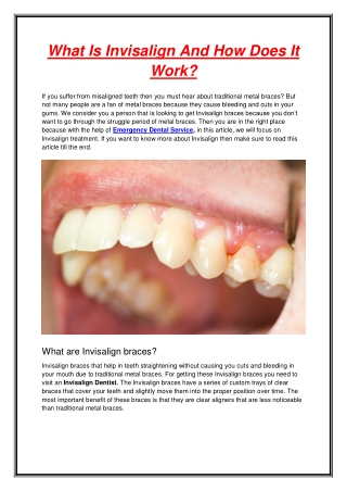 What Is Invisalign And How Does It Work