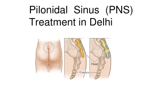 Pilonidal Sinus (PNS) Treatment in Delhi