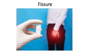 Ayurvedic Treatment for Fissure