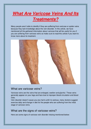 What Are Varicose Veins And Its Treatments