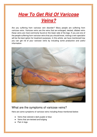 How To Get Rid Of Varicose Veins