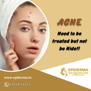 Advanced Acne Treatment | Best skin clinic in Jayanagar | Epiderma Clinic