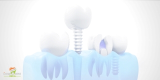 Comsodent India For Dental Implants in Gurgaon