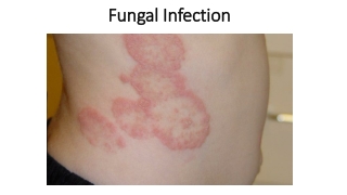 Ayurvedic Treatment for Fungal Infection