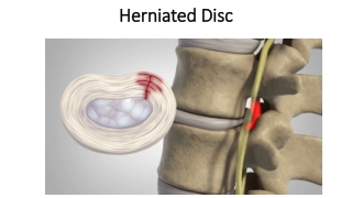 Ayurvedic Treatment for Herniated Disc
