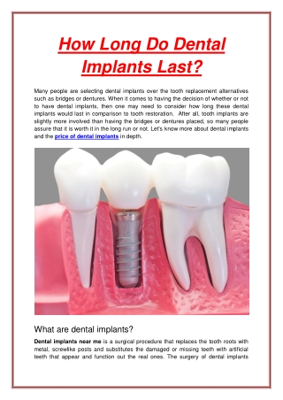How Long Do Dental  Implants Last