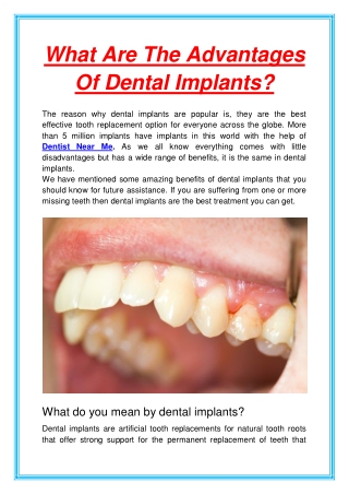 What Are The Advantages Of Dental Implants