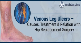 Risk Factors Associated With Venous Leg After Hip Replacement | Mr Mehta spine