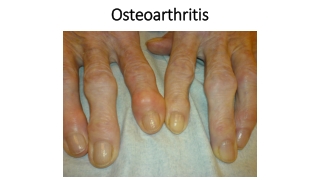 Best Ayurvedic Treatment for Osteoarthritis
