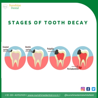 Stages of Tooth Decay | Best Orthodontists In Whitefield