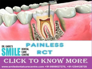 Painless Root Canal Treatment in Faridabad India at Affordable Cost