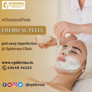 Chemical peeling Treatment | Best Skin Clinic in Jayanagar | Epiderma Clinic