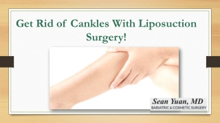 Get Rid of Cankles With Liposuction Surgery!