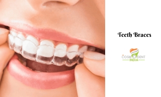 Teeth Braces Cost in Delhi