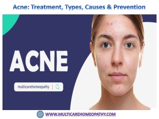 Acne: Treatment, Types, Causes & Prevention