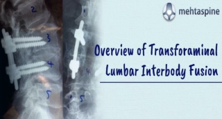 Overview of Transforaminal Lumbar Interbody Fusion |Mehta Spine