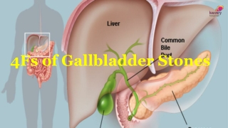 4Fs of Gallbladder Stones