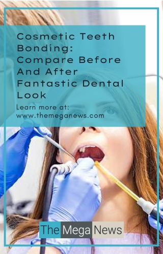Cosmetic Teeth Bonding Before and After