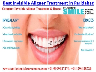 Best Invisible Aligner Treatment in India  at Smile Dental Care Centre