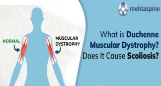 What is Duchenne Muscular Dystrophy? Does It Cause Scoliosis?