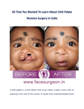 Cleft Palate Revision Surgery in India | All That You Wanted to Know About the P
