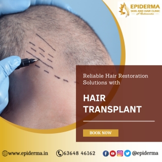 Hair Transplantation - Best Hair Transplantation in Jayanagar - Epiderma Clinic