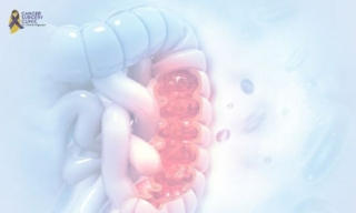 Cancer Surgery Clinic in Mumbai For Oncologist Doctor